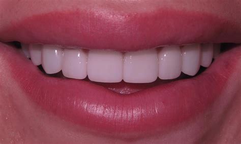 porcelain veneers in burnsville mn|Cosmetic Dentistry .